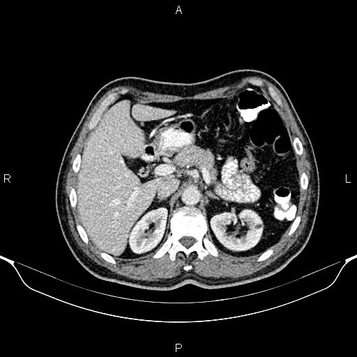 Cecal adenocarcinoma (Radiopaedia 85324-100916 B 26).jpg