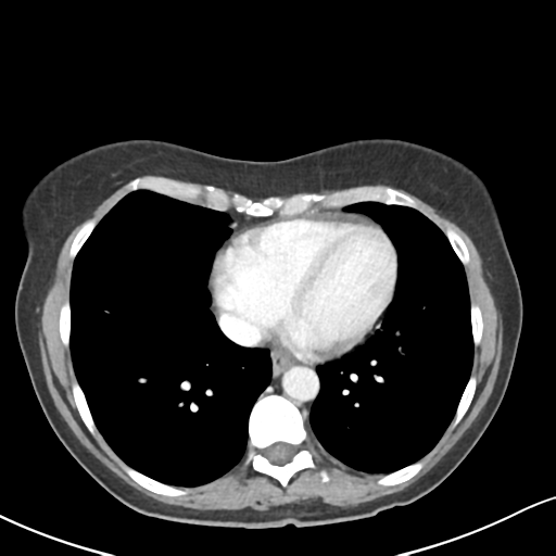 Cecal internal hernia through the foramen of Winslow (Radiopaedia 44820-48651 B 1).png