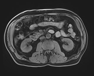 Cecal mass causing appendicitis (Radiopaedia 59207-66532 Axial T1 64).jpg