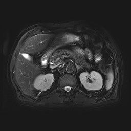 File:Cecal mass causing appendicitis (Radiopaedia 59207-66532 Axial T2 fat sat 16).jpg