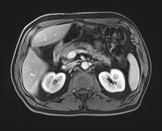 Cecal mass causing appendicitis (Radiopaedia 59207-66532 T1 C+ PV phase 51).jpg