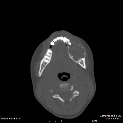File:Central giant cell granuloma (Radiopaedia 45612-49754 Axial bone window 17).jpg