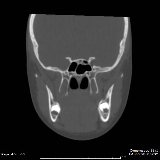 File:Central giant cell granuloma (Radiopaedia 45612-49754 Coronal bone window 40).jpg