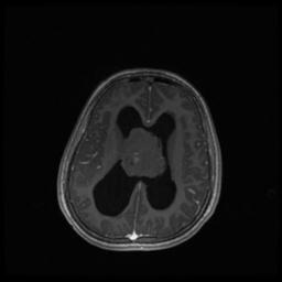 Central neurocytoma (Radiopaedia 30220-30842 Axial T1 C+ 93).jpg