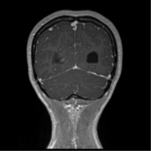 Central neurocytoma (Radiopaedia 37664-39557 Coronal T1 C+ 17).png