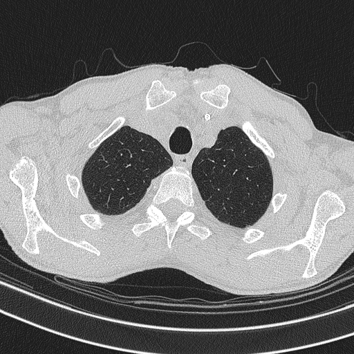 Central venous catheter tip extravasation (Radiopaedia 82828-97113 Axial lung window 16).jpg