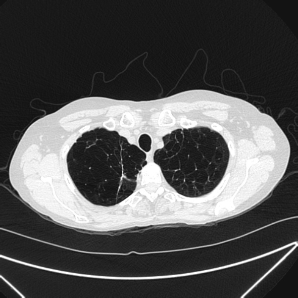 Centrilobular pulmonary emphysema (Radiopaedia 24495-24789 Axial lung window 13).jpg