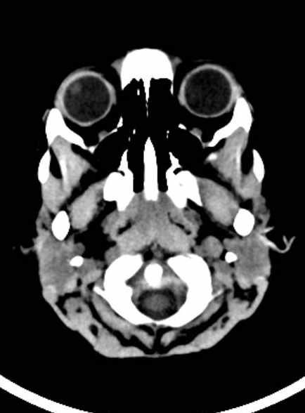 Cerebellar abscess (Radiopaedia 73727-84527 Axial non-contrast 19).jpg