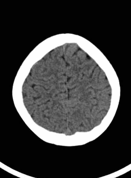 File:Cerebellar abscess (Radiopaedia 73727-84527 Axial non-contrast 55).jpg
