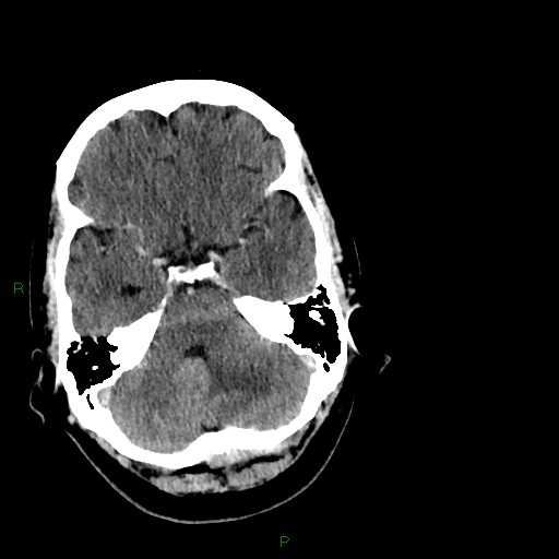 Cerebellar abscess (Radiopaedia 78135-90671 Axial C+ delayed 31).jpg