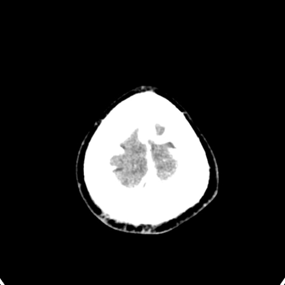 Cerebellar abscess secondary to mastoiditis (Radiopaedia 26284-26412 Axial C+ delayed 147).jpg