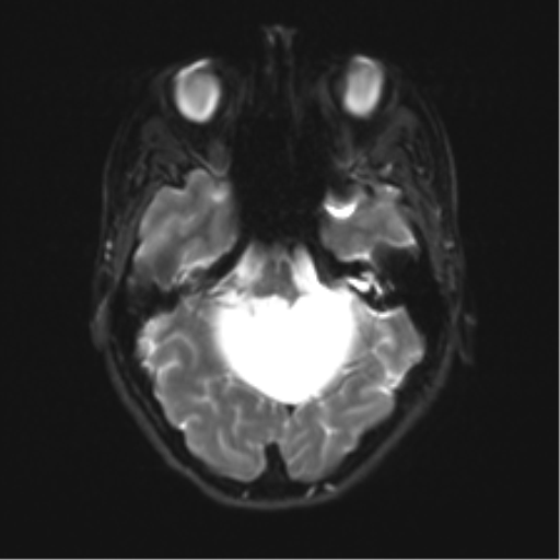 Cerebellar agenesis with hypoplastic pons (pontocerebellar hypoplasia) (Radiopaedia 57224-64138 Axial DWI 12).png