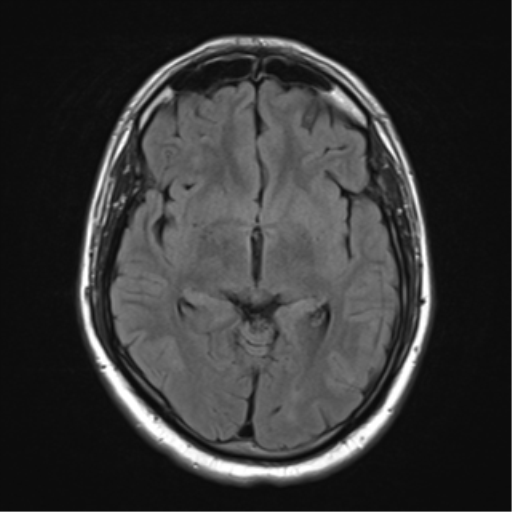 File:Cerebellar hemangioblastomas and pituitary adenoma (Radiopaedia 85490-101176 Axial FLAIR 14).png