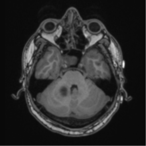 Cerebellar hemangioblastomas and pituitary adenoma (Radiopaedia 85490-101176 Axial T1 21).png
