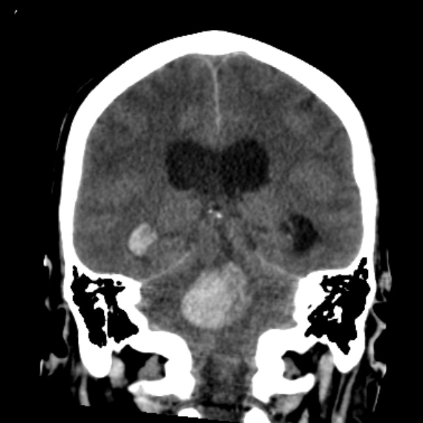 Cerebellar hemorrhage causing obstructive hydrocephalus (Radiopaedia 33989-35207 Coronal non-contrast 34).jpg