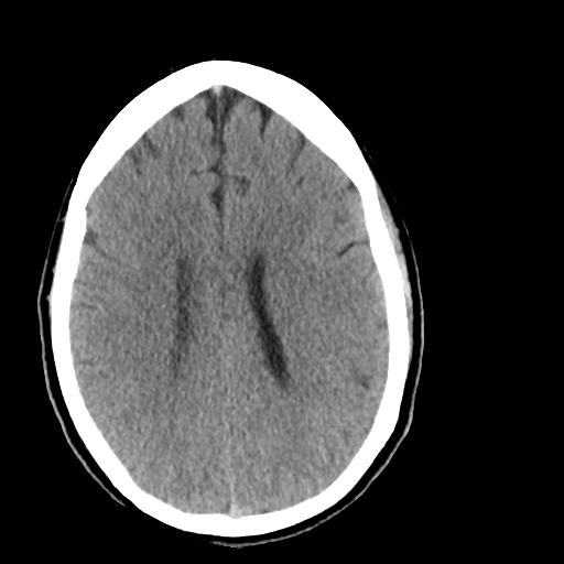 File:Cerebellar infarct due to vertebral artery dissection with posterior fossa decompression (Radiopaedia 82779-97029 Axial non-contrast 18).png