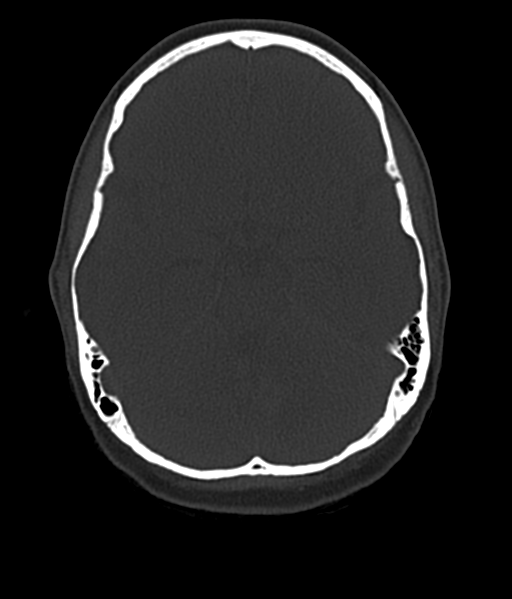 Cerebellar metastases - colorectal adenocarcinoma (Radiopaedia 40947-43652 AX Bone C- 2.0 MPR 21).png