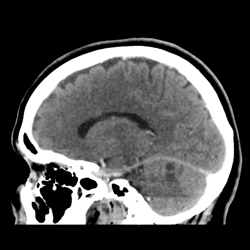 Cerebellar metastasis (cystic appearance) (Radiopaedia 41395-44258 F 32).png