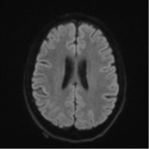 Cerebellar metastasis - adenocarcinoma lung (Radiopaedia 63184-71715 Axial DWI 48).png