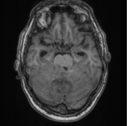 Cerebellar metastasis from lung adenocarcinoma (Radiopaedia 86690-102829 Axial T1 29).png