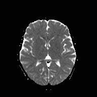 File:Cerebellar stroke (Radiopaedia 32202-33150 Axial ADC 13).png