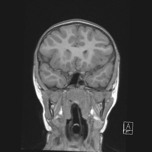 Cerebellar stroke (Radiopaedia 32202-33150 Coronal T1 21).png