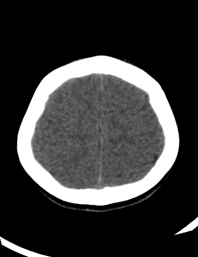File:Cerebellitis (Radiopaedia 63148-71665 Axial non-contrast 9).jpg