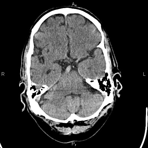 Cerebellopontine angle arachnoid cyst (Radiopaedia 85149-100704 Axial With contrast 13).jpg