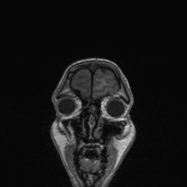 Cerebral abscess (Radiopaedia 24212-24478 Coronal T1 37).jpg