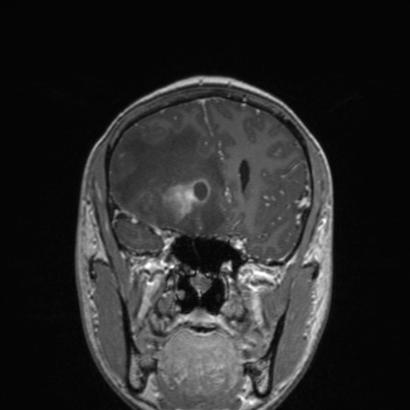 File:Cerebral abscess (Radiopaedia 24212-24478 Coronal T1 C+ 78).jpg