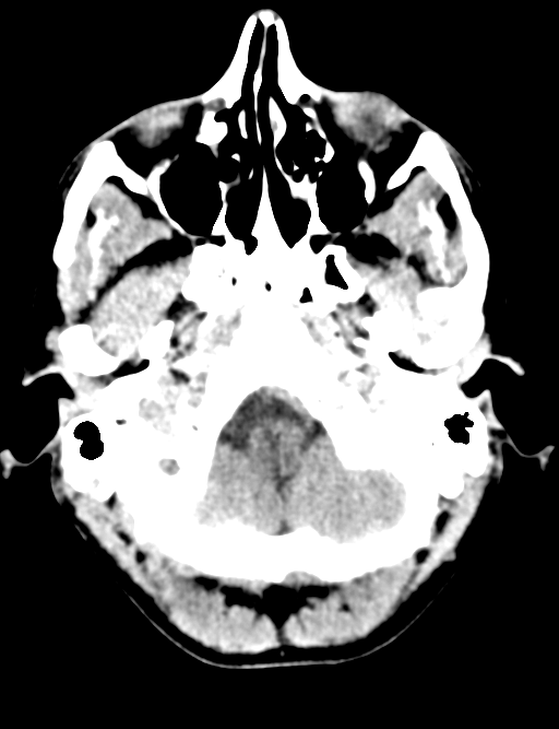 Cerebral abscess (Radiopaedia 60342-68008 Axial non-contrast 8).png