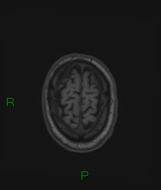 File:Cerebral abscess and subdural empyema (Radiopaedia 84436-99779 Axial T1 15).jpg
