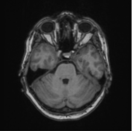 Cerebral abscess from pulmonary arteriovenous malformation (Radiopaedia 86275-102291 Axial T1 25).png
