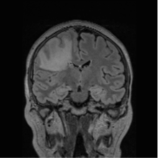Cerebral abscess from pulmonary arteriovenous malformation (Radiopaedia 86275-102291 Coronal FLAIR 47).png
