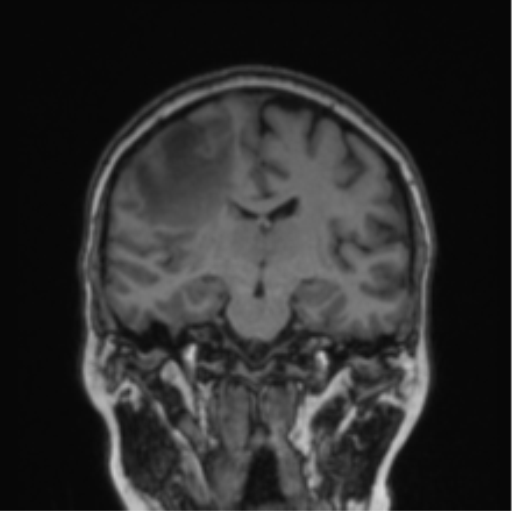 Cerebral abscess from pulmonary arteriovenous malformation (Radiopaedia 86275-102291 Coronal T1 46).png