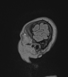 Cerebral abscess from pulmonary arteriovenous malformation (Radiopaedia 86275-102291 Sagittal FLAIR 8).png