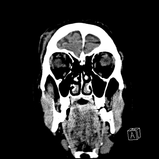 File:Cerebral abscess with ventriculitis (Radiopaedia 78965-91876 B 9).jpg