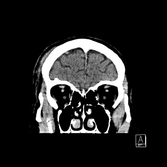 File:Cerebral abscess with ventriculitis (Radiopaedia 78965-91877 B 11).jpg
