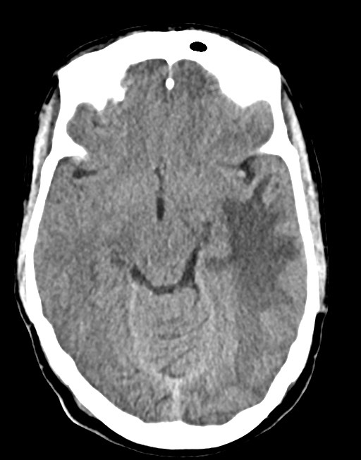 Cerebral abscesses (Radiopaedia 70458-80568 Axial non-contrast 27).jpg