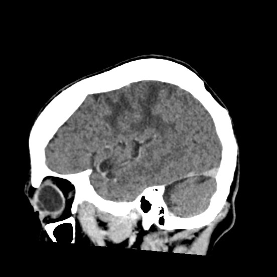 Cerebral amyloid angiopathy-related inflammation (Radiopaedia 74836-85848 C 15).jpg