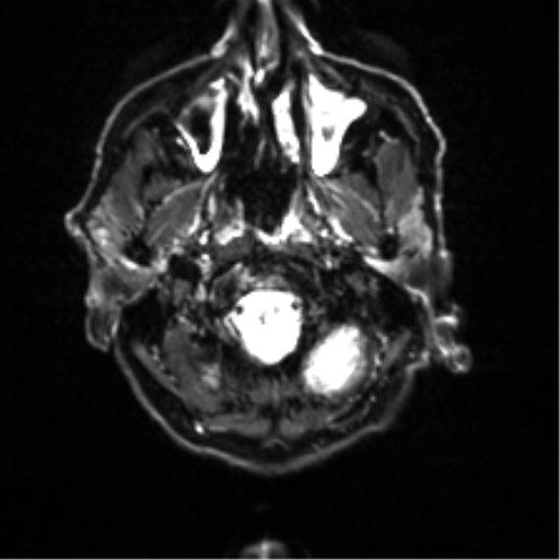 File:Cerebral amyloid angiopathy (Radiopaedia 46082-50433 Axial DWI 1).png