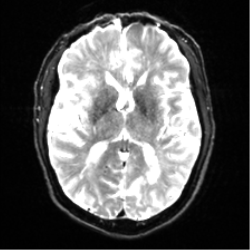 Cerebral amyloid angiopathy (Radiopaedia 46082-50433 Axial DWI 14).png