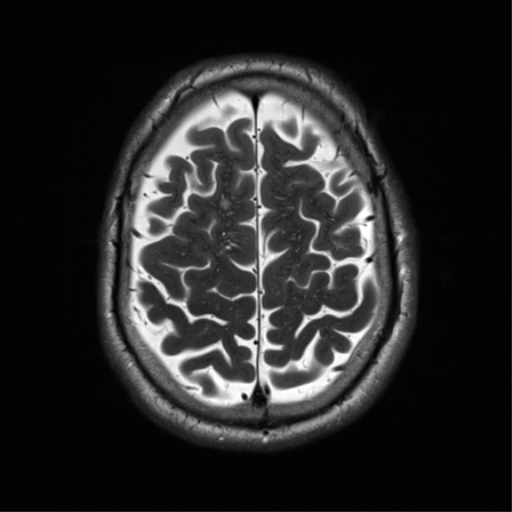 File:Cerebral amyloid angiopathy (Radiopaedia 46082-50433 Axial T2 30).png