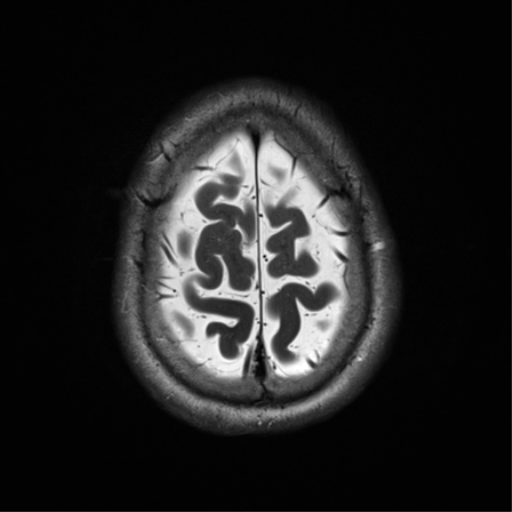 File:Cerebral amyloid angiopathy (Radiopaedia 46082-50433 Axial T2 33).png