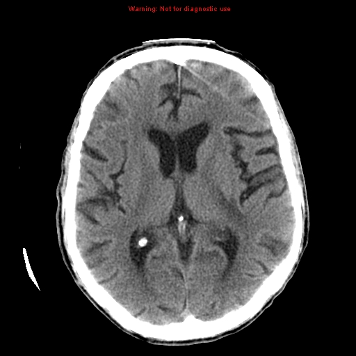 File:Cerebral and orbital tuberculomas (Radiopaedia 13308-13310 Axial non-contrast 34).jpg