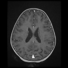 Cerebral and spinal tuberculosis (Radiopaedia 90489-107837 Axial T1 C+ 126).jpg