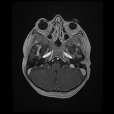 Cerebral and spinal tuberculosis (Radiopaedia 90489-107837 Axial T1 C+ 53).jpg