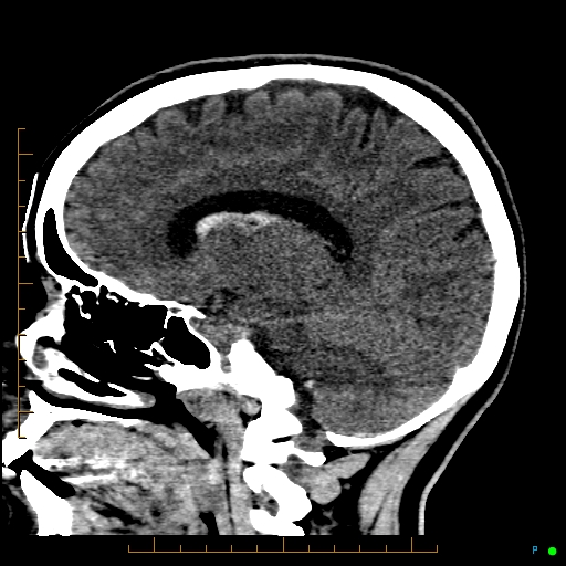 Cerebral arteriovenous malformation (AVM) (Radiopaedia 78162-90706 A 46).jpg