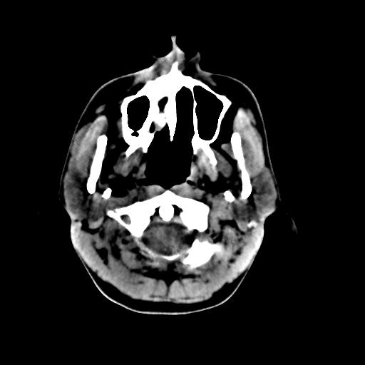 Cerebral arteriovenous malformation (Radiopaedia 28518-28759 Axial non-contrast 2).jpg