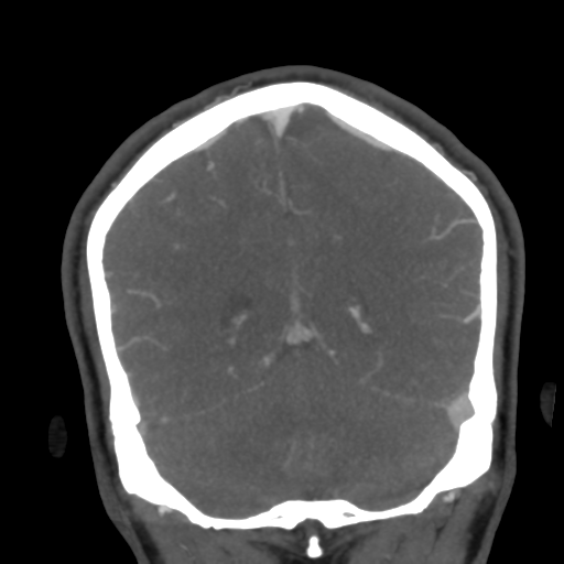 Cerebral arteriovenous malformation (Radiopaedia 39259-41505 E 49).png